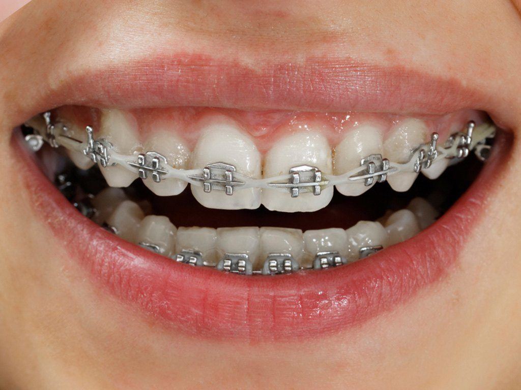 Braces